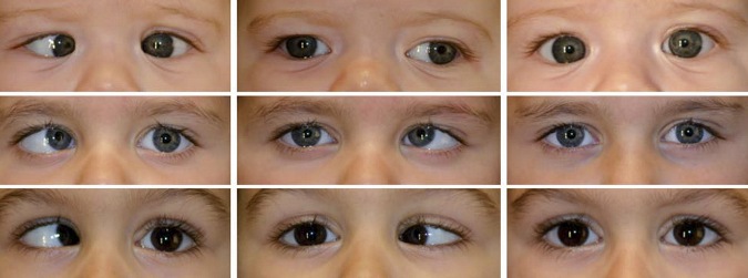 La Ambliopía u “ojo perezoso” afecta muchos niños: Clínica de la Visión te explica la importancia de consultar a tiempo