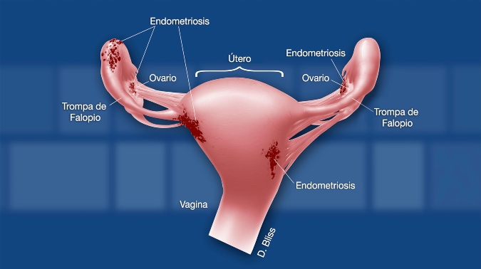 endometriosis1 - Diario El Cuco Digital todas las noticias del Valle de Uco endometriosis1