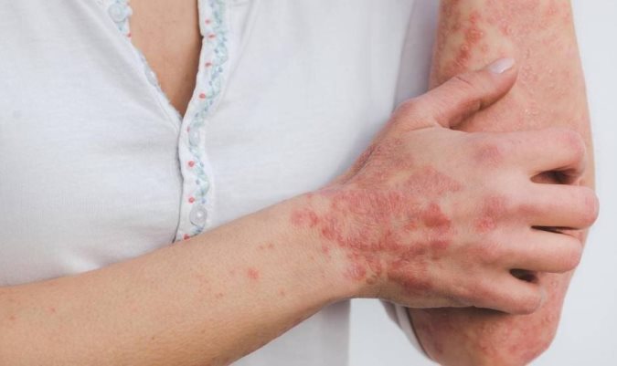 Efemérides: cada 29 de octubre se celebra el Día Mundial de la Psoriasis