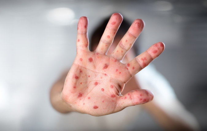 La viruela símica se detectó por primera vez en los seres humanos en 1970.