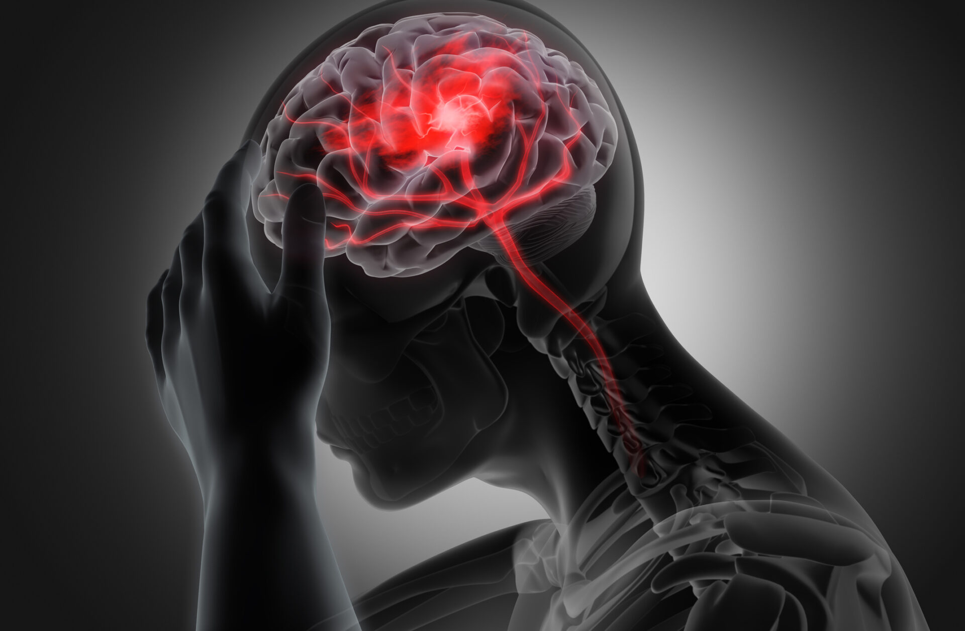 accidente-cerebrovascular